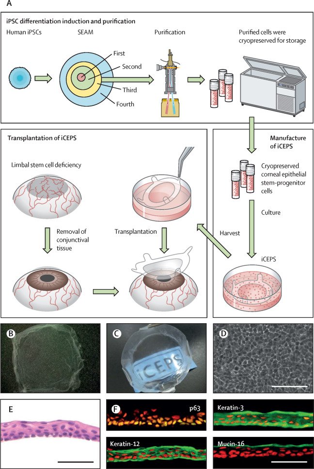 Scientists have restored vision in patients using stem cells